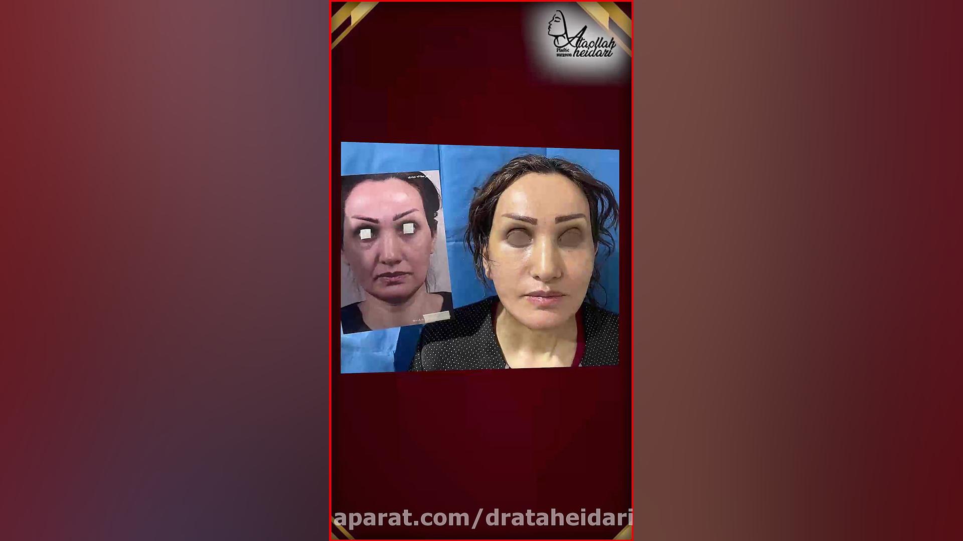 لیفت صورت ، پیشانی و گردن ، بلفاروپلاستی تحتانی و تزریق چربی تریلر تصویربرداری بالینی