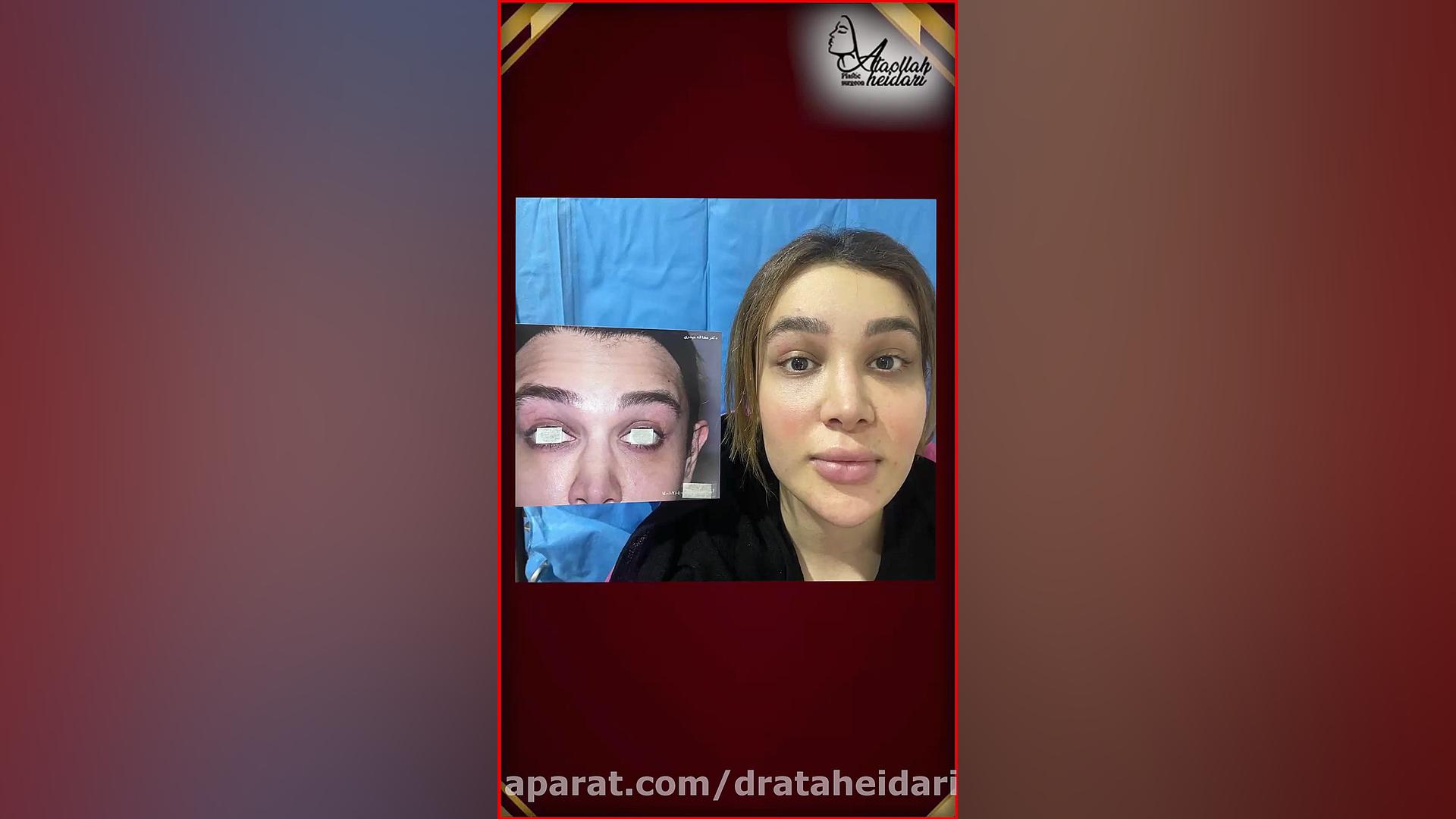 لیفت اندوسکوپی پیشانی و لیفت ابرو بیماری سندروم آلاژیل