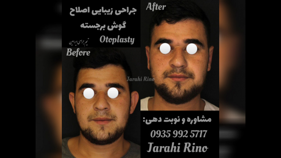 جراحی اصلاح گوش برجسته یا اتوپلاستی | تیم جراحی ایرامین علامت لاسگ