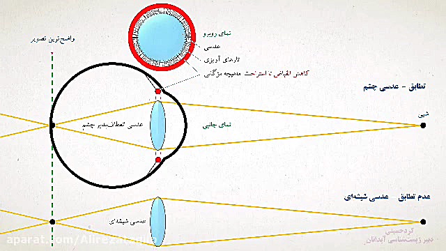 تطابق عدسی چشم ویدیو قندی
