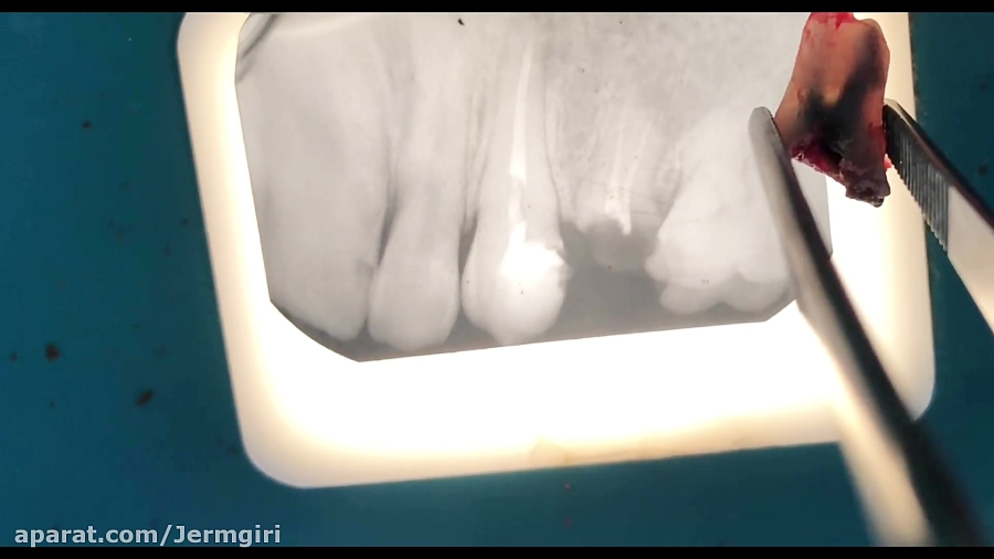 كشيدن دندان و معالجه.مهدی سطوتی