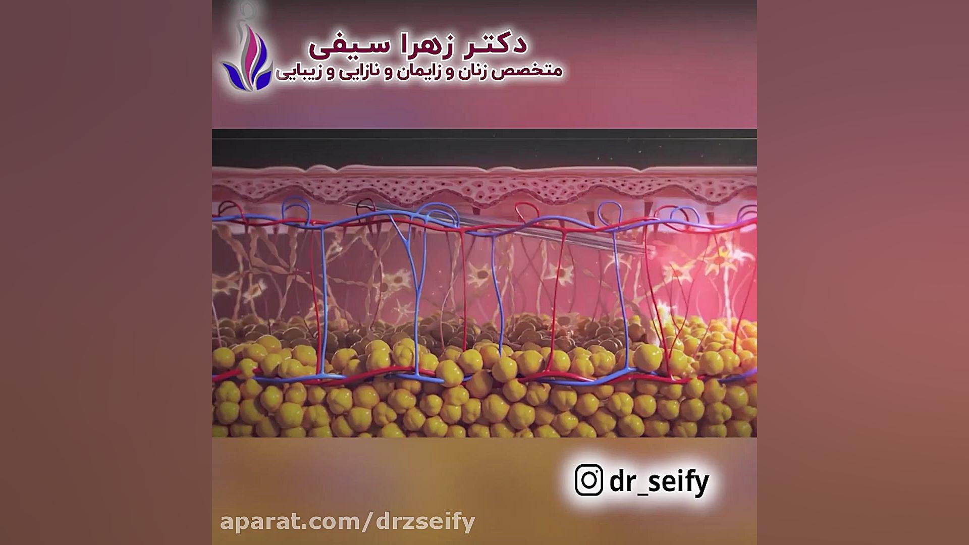 دائمی ترین راه سفید کردن واژن| دکتر زهرا سیفی | متخصص زنان زایمان نازایی شکیرا