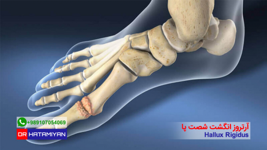 آیا شست پا هم دچار آرتروز می‌شود؟ کلینیک مو