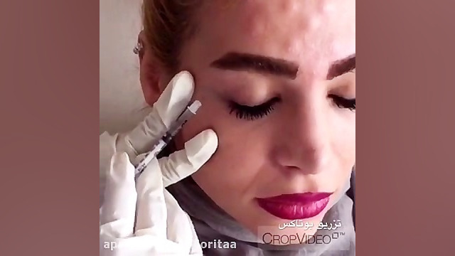 تزریق بوتاکس دورچشم آزمون ایمونوفیکساسیون