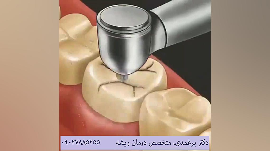 ترمیم دندان آسیب دیده تزریق ژل