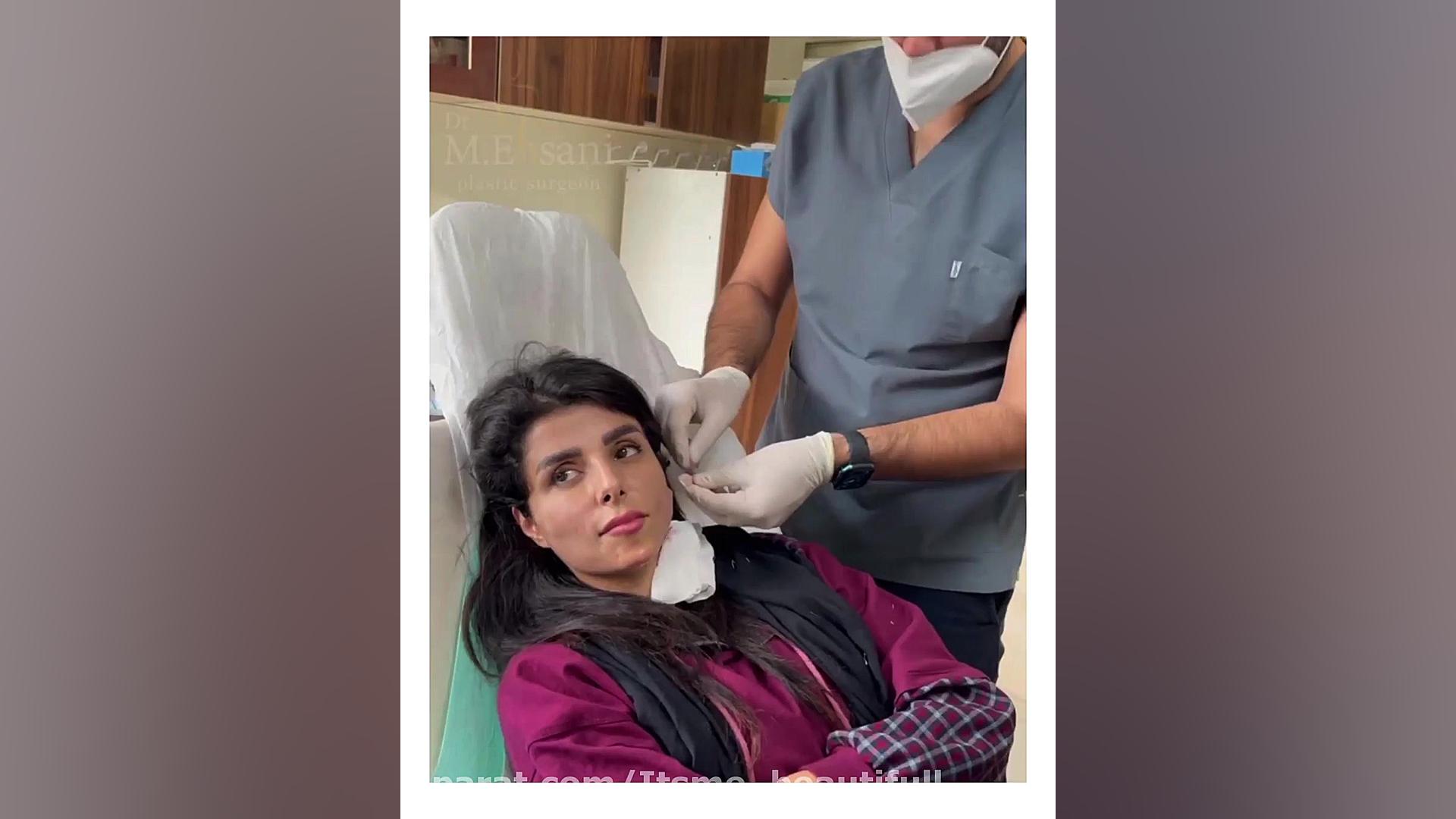 لیفت صورت با نخ لیپوماتیک