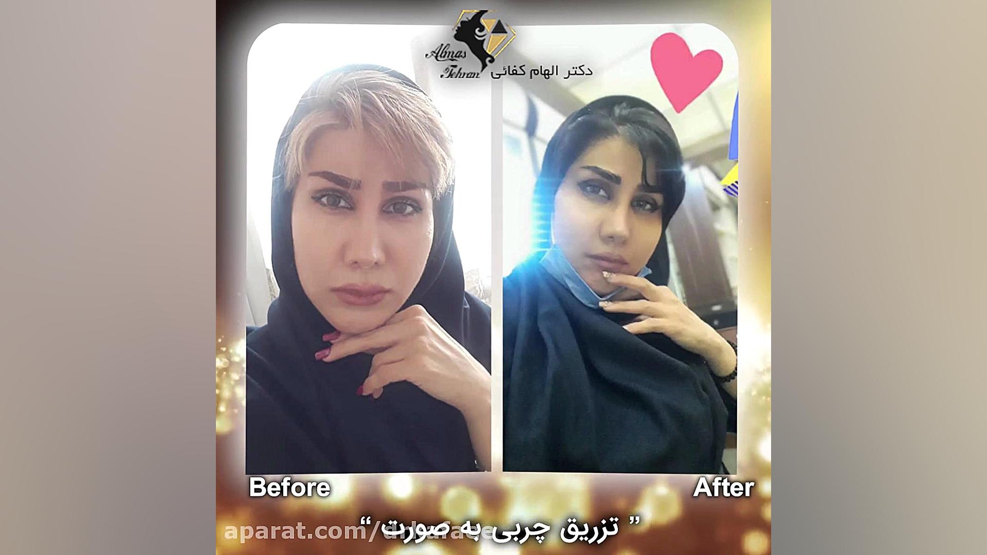 عکس های قبل و یک ماه بعد از تزریق چربی به صورت HIDA Scan