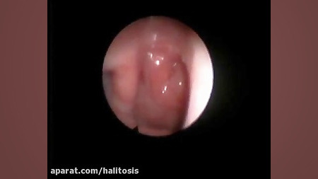 لارنگوسکوپی حنجره قابل انعطاف (flexible laryngoscopy) رفع چین و چروک