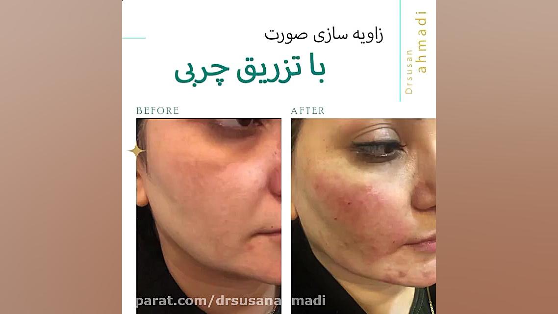 فیلم واقعی زاویه سازی صورت با تزریق چربی دکتر سوسن احمدی پیر شهید