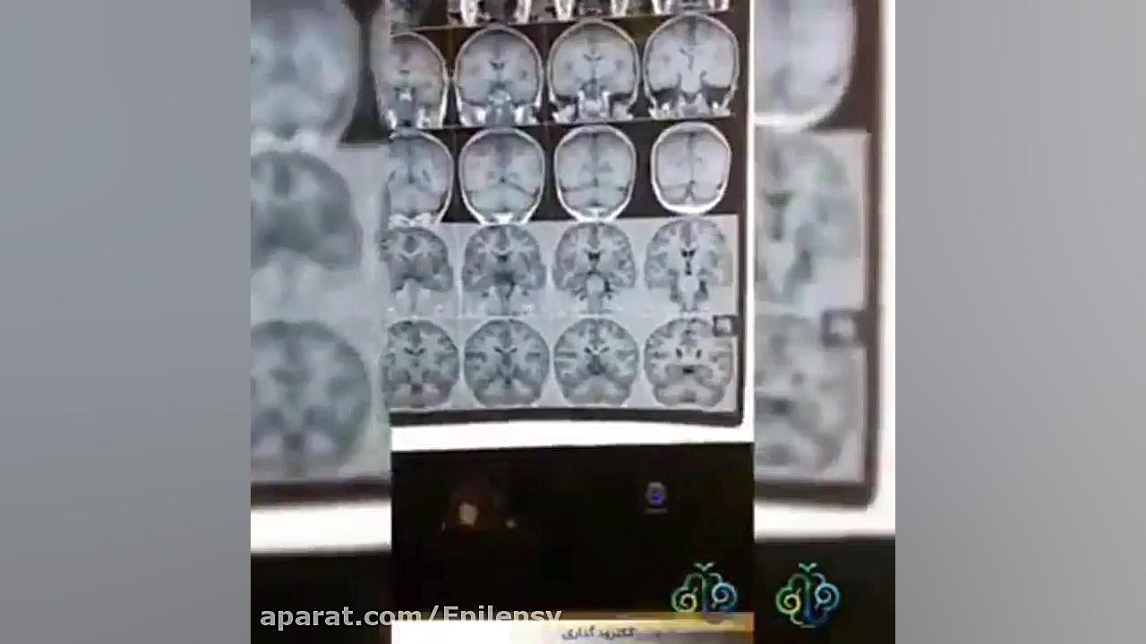 جراحی صرع با روش الکترود گذاری پاکسازی پوست