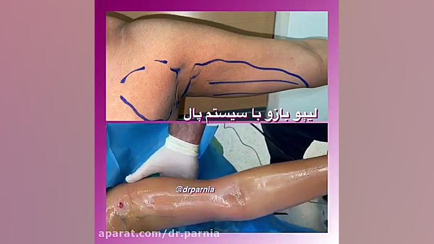 لیپو بازو با سیستم پال دکتر رفیع پرنیا فوق تخصص پلاستیک