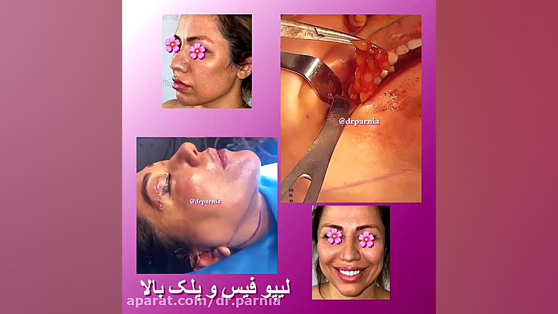 لیپو فیس دکتر رفیع پرنیا فوق تخصص پلاستیک