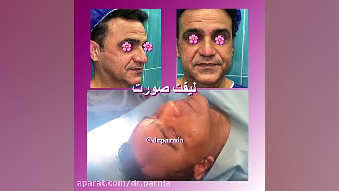 جراحی لیفت صورت دکتر رفیع پرنیا فوق تخصص پلاستیک