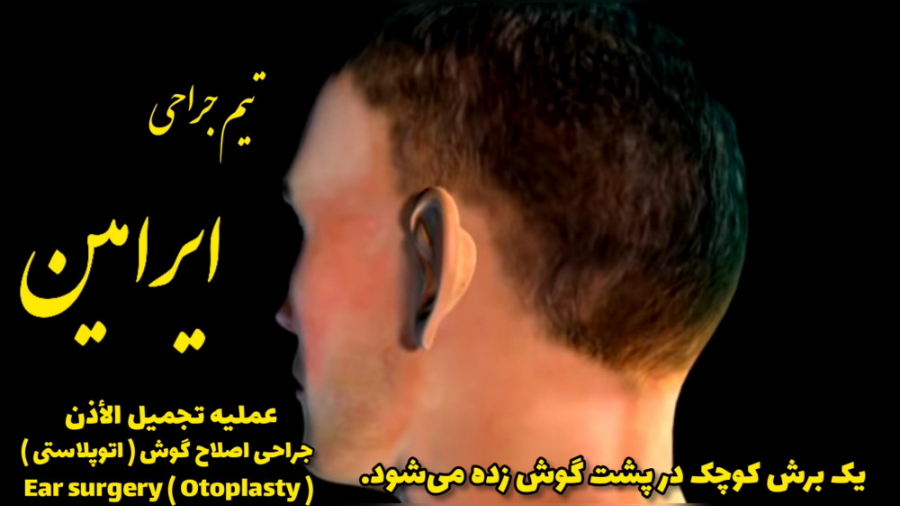 انیمیشن جراحی اصلاح گوش برجسته اتوپلاستی | تیم جراحی ایرامین انیدروز