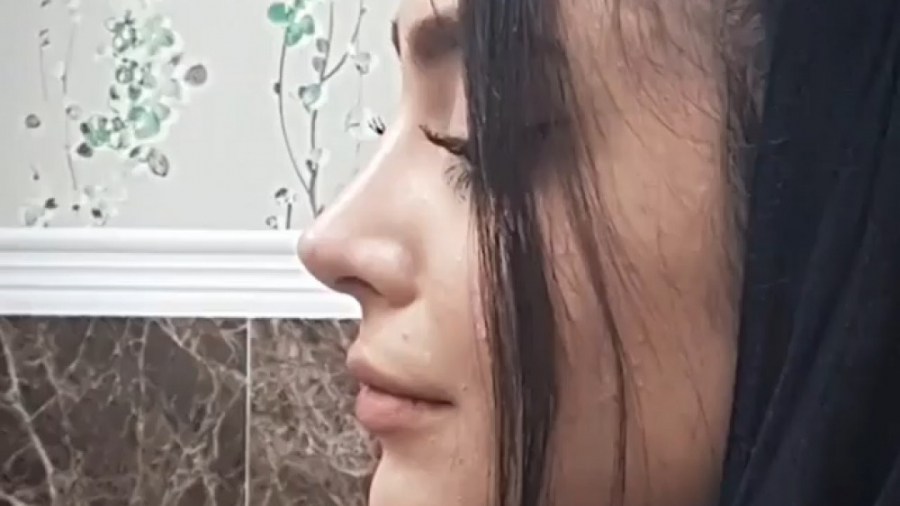 شش ماه پس از جراحی بینی به سبک نچرال استتیک دکتر فاطمه مختاری فر جراح بینی در لرستان