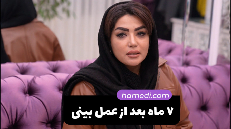 7 ماه بعد از عمل زیبایی بینی در مشهد توسط دکتر حسین حامدی بررسی اروماتاز