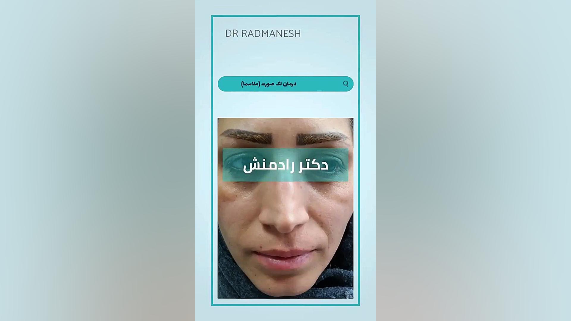 درمان لک صورت (ملاسما) با لیزر دندانپزشک زیبایی
