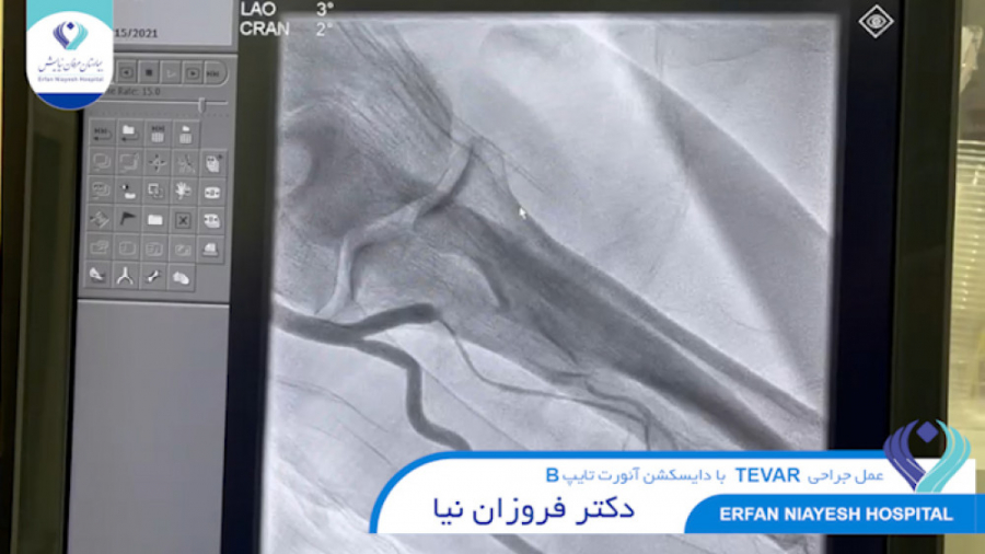 1400.08.29 - عمل جراحي TEVAR در بيمار با دايسكش آئورت تايپ B تست تنفس اوره C13