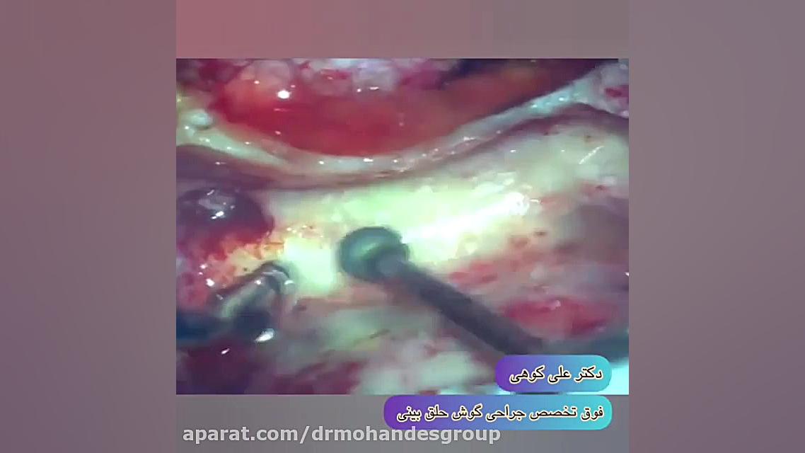 فلج نیمه صورت لمینت