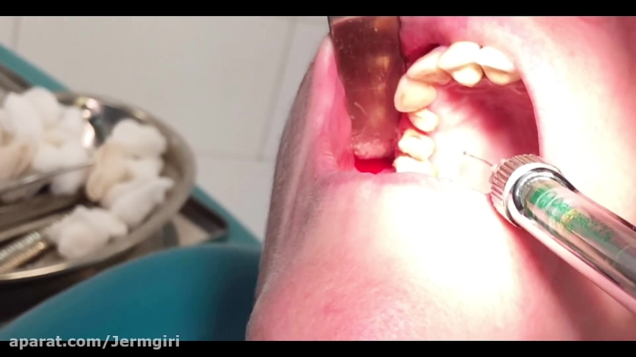 جراحى كيست. مهدی سطوتی