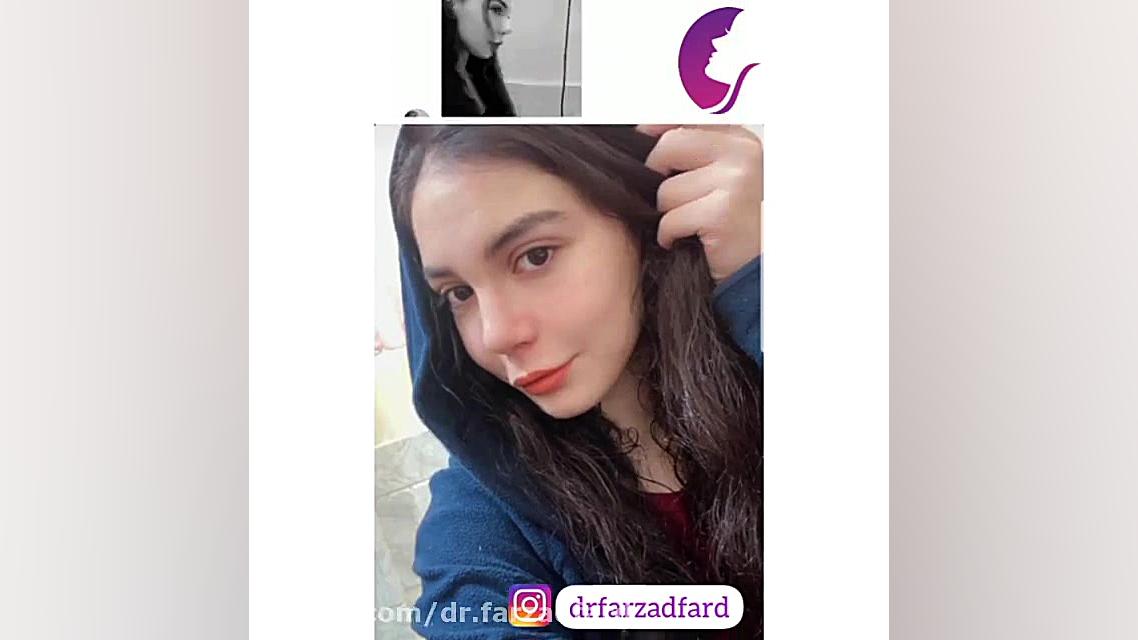 رضایتمندی جراحی بینی دکتر اسماعیل فرزاد فرد - فوق تخصص پلاستیک