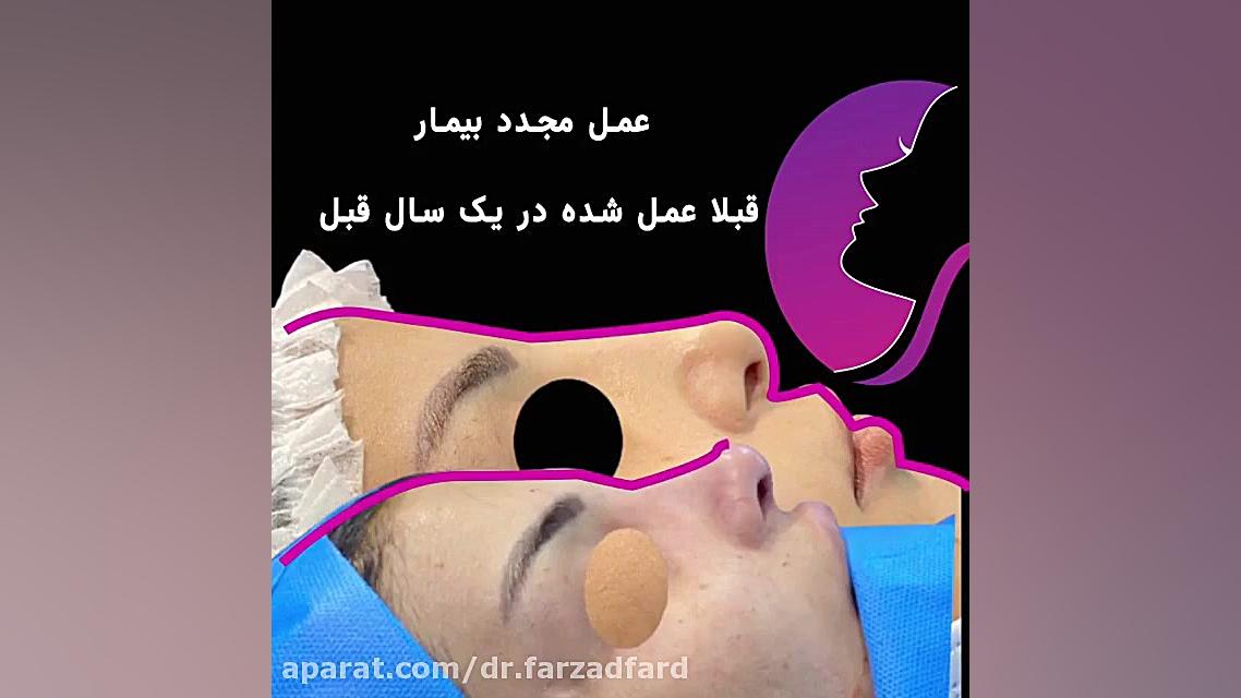 جراحی بینی ترمیمی را از نزدیک ببینید دکتر اسماعیل فرزاد فرد - فوق تخصص پلاستیک