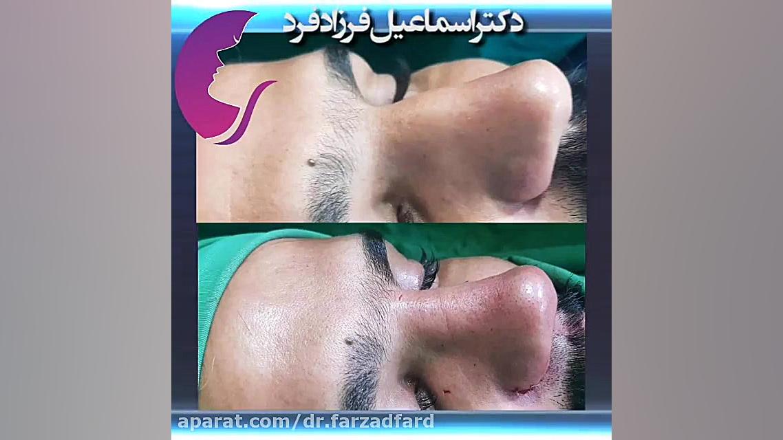 فیلم از نزدیک و اتاق عمل عمل بینی مردانه دکتر اسماعیل فرزاد فرد - فوق تخصص پلاستیک
