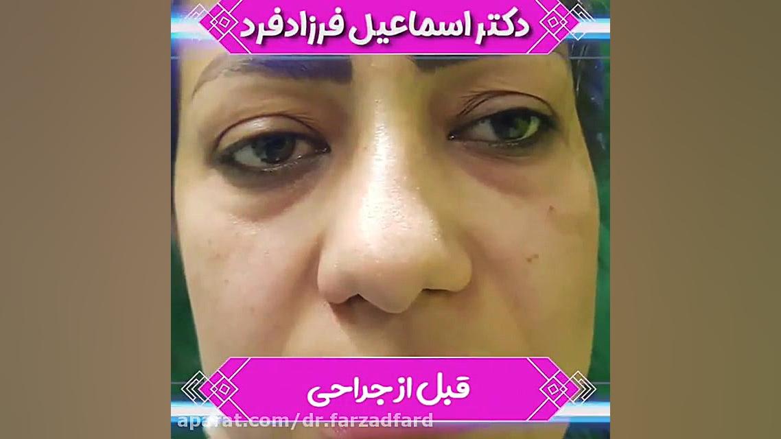 جراحی همزمان بینی و پلک دکتر اسماعیل فرزاد فرد - فوق تخصص پلاستیک
