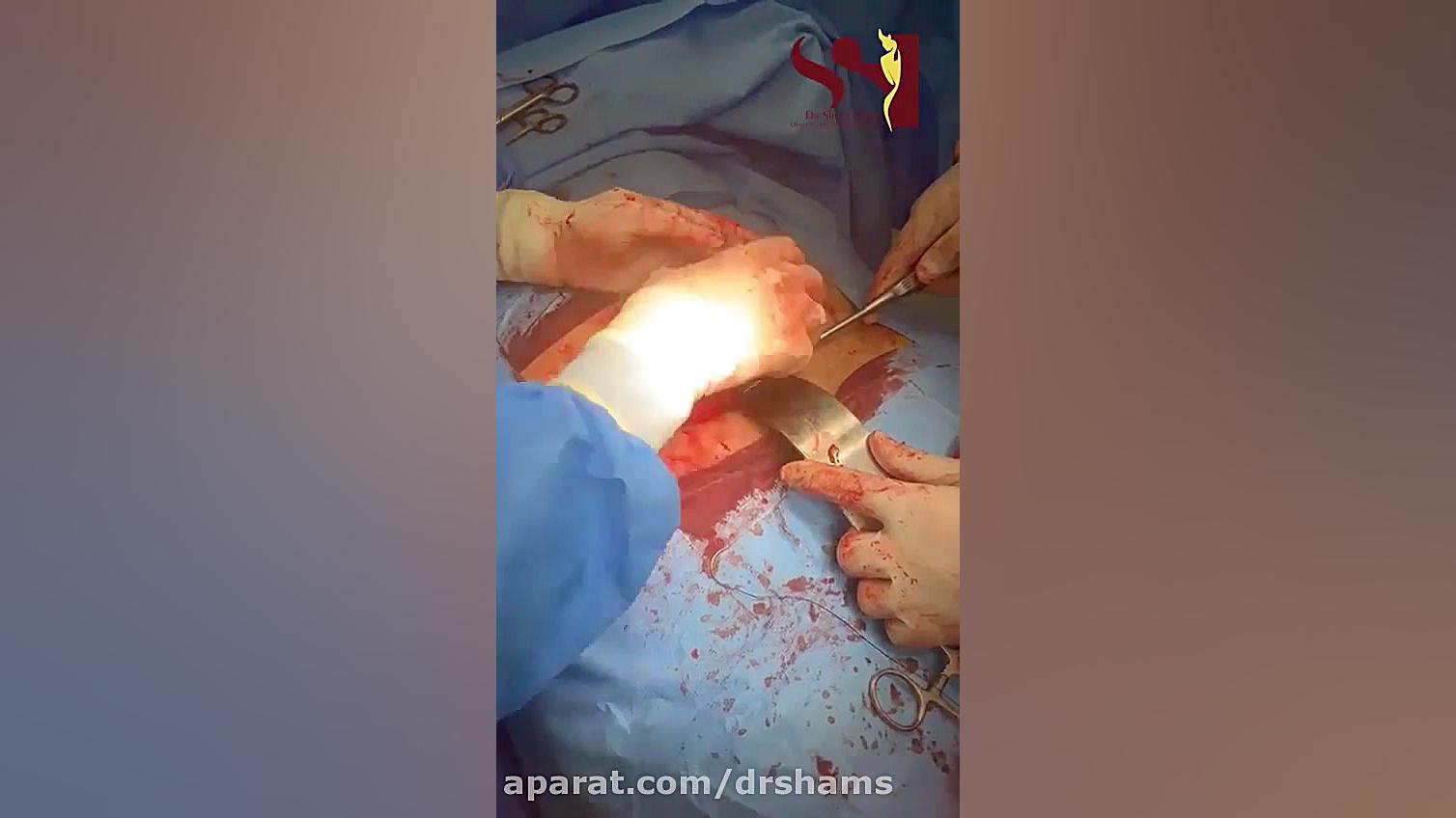 فیلم واقعی جراحی برداشتن رحم خانم ۴۵ ساله دکتر شیرین شمس جراح و متخصص زنان و زایمان