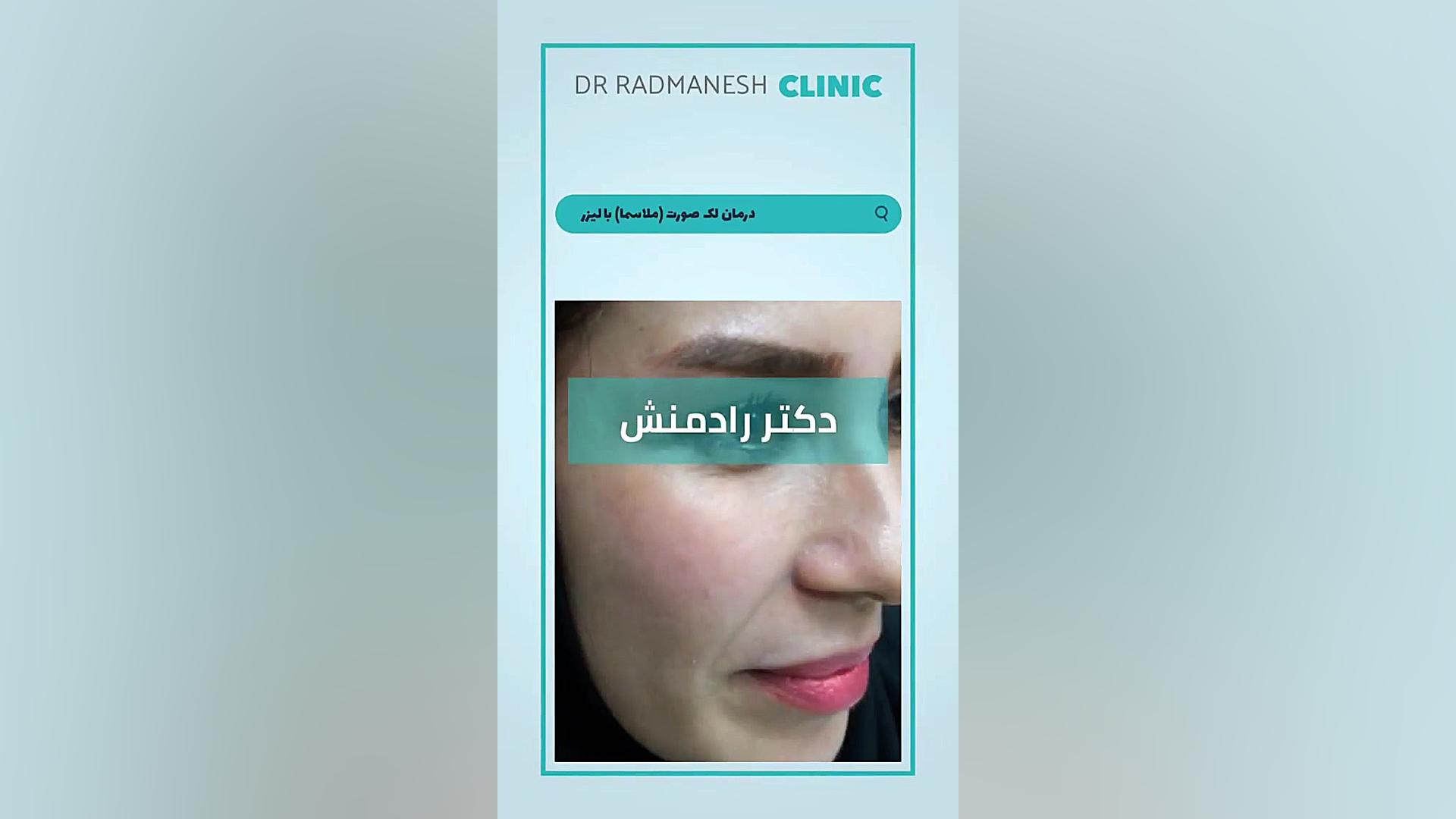 درمان لک صورت (ملاسما) با لیزر پریودنتیکس
