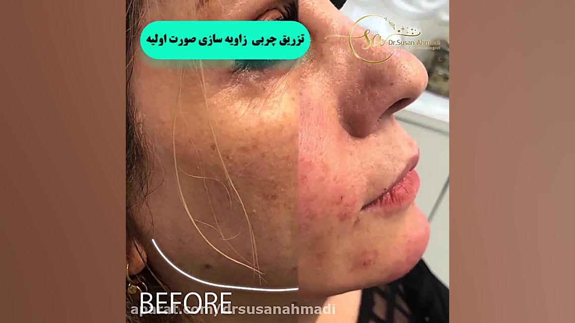 فیلم واقعی تزریق چربی و زاویه سازی کامل صورت دکتر سوسن احمدی پیر شهید
