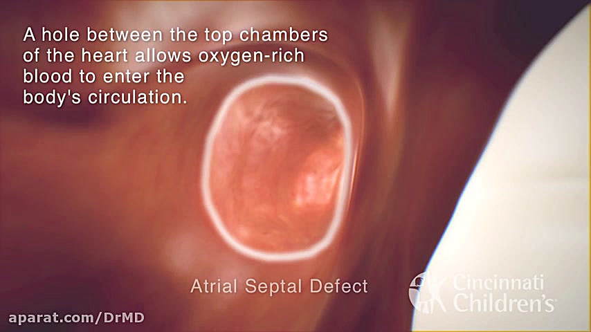 TAPVR Total Anomalous Pulmonary Venous Return دکتر مهدی صادقی