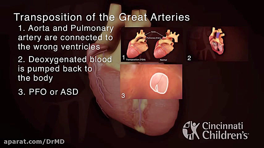 Transposition of the great arteries TGA دکتر مهدی صادقی