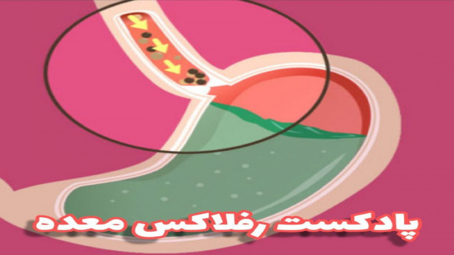 پادکست رفلاکس معده و روش‌های درمان رفلاکس اتوپلاستی