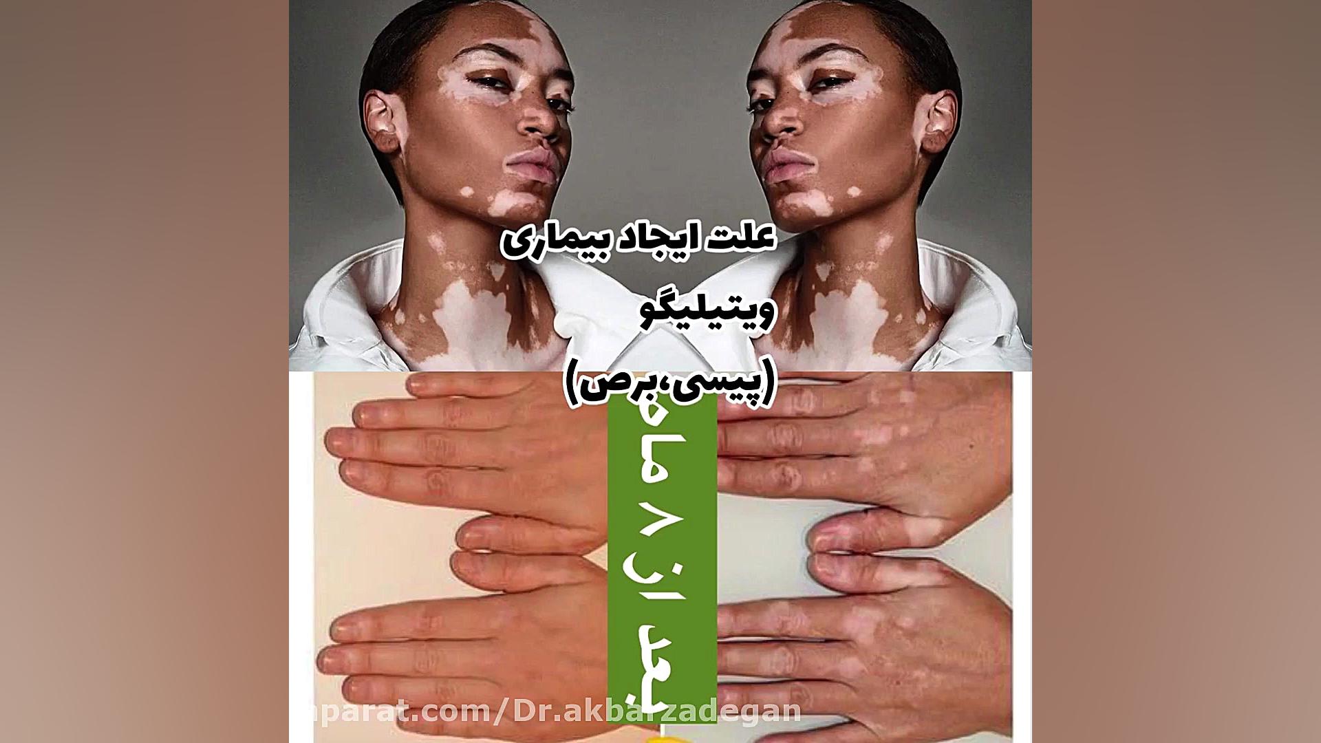 پیسی یا ویتیلیگو (برص) چیست آیا درمان قطعی دارد؟ شبنم قلی‌خانی