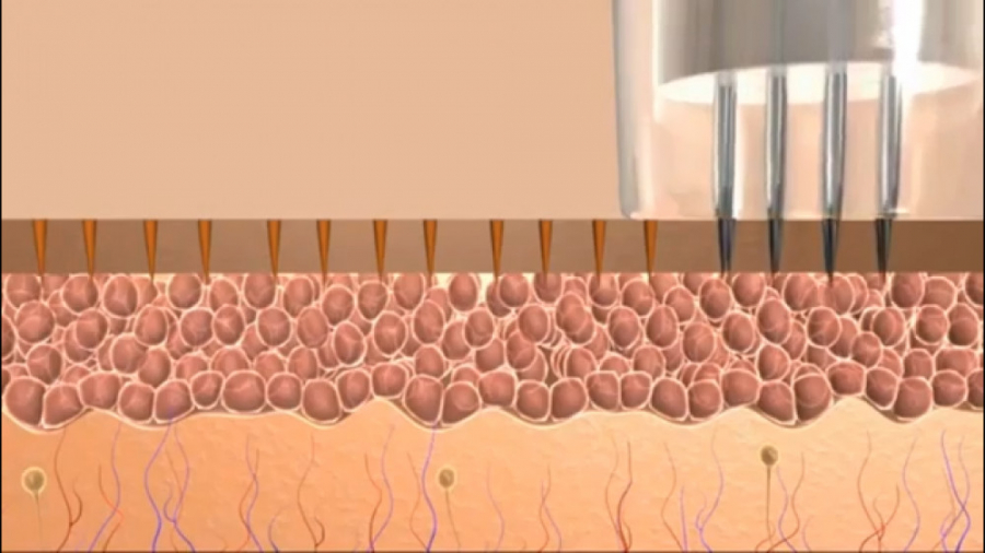 میکرونیدلینگ پوست صورت دستگاه DNA-Chip