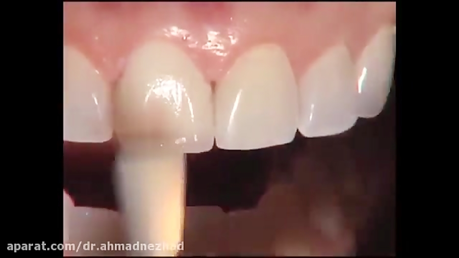 پروتز کامل پرسلن زیرکونیا ASO Test