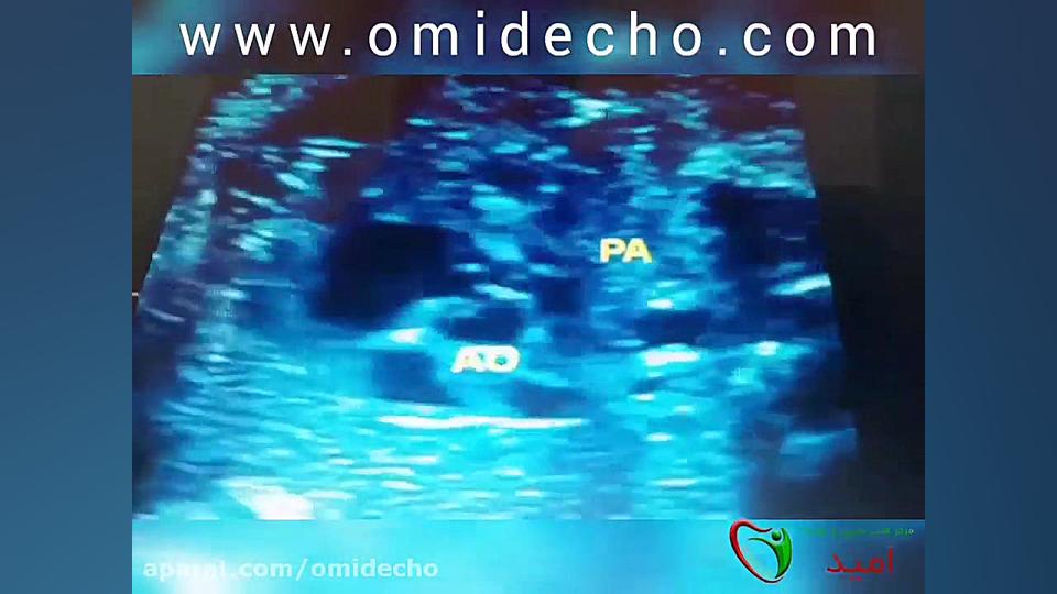 فیلم اکو قلب جنین بیست هفته مهندسی ژنوم انسانی