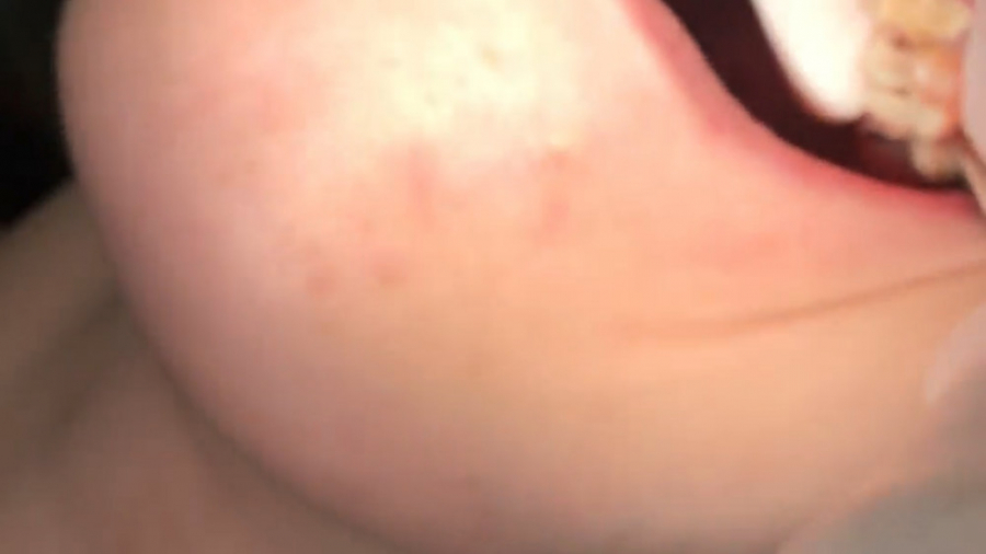 كشيدن دندان شكسته. مهدی سطوتی