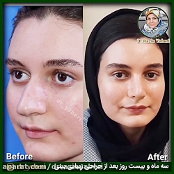 سه ماه و بیست روز بعد از جراحی زیبایی بینی ( رینوپلاستی ) سه ماه و بیست روز بعد از جراحی زیبایی بینی ( رینوپلاستی )