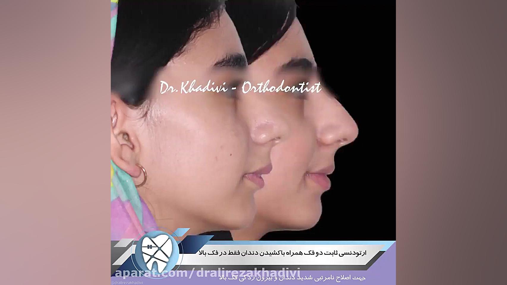 ارتودنسی ثابت به همراه کشیدن در فک بالا.متخصص ارتودنسی دکترعلیرضاخدیوی دکتر علیرضا خدیوی