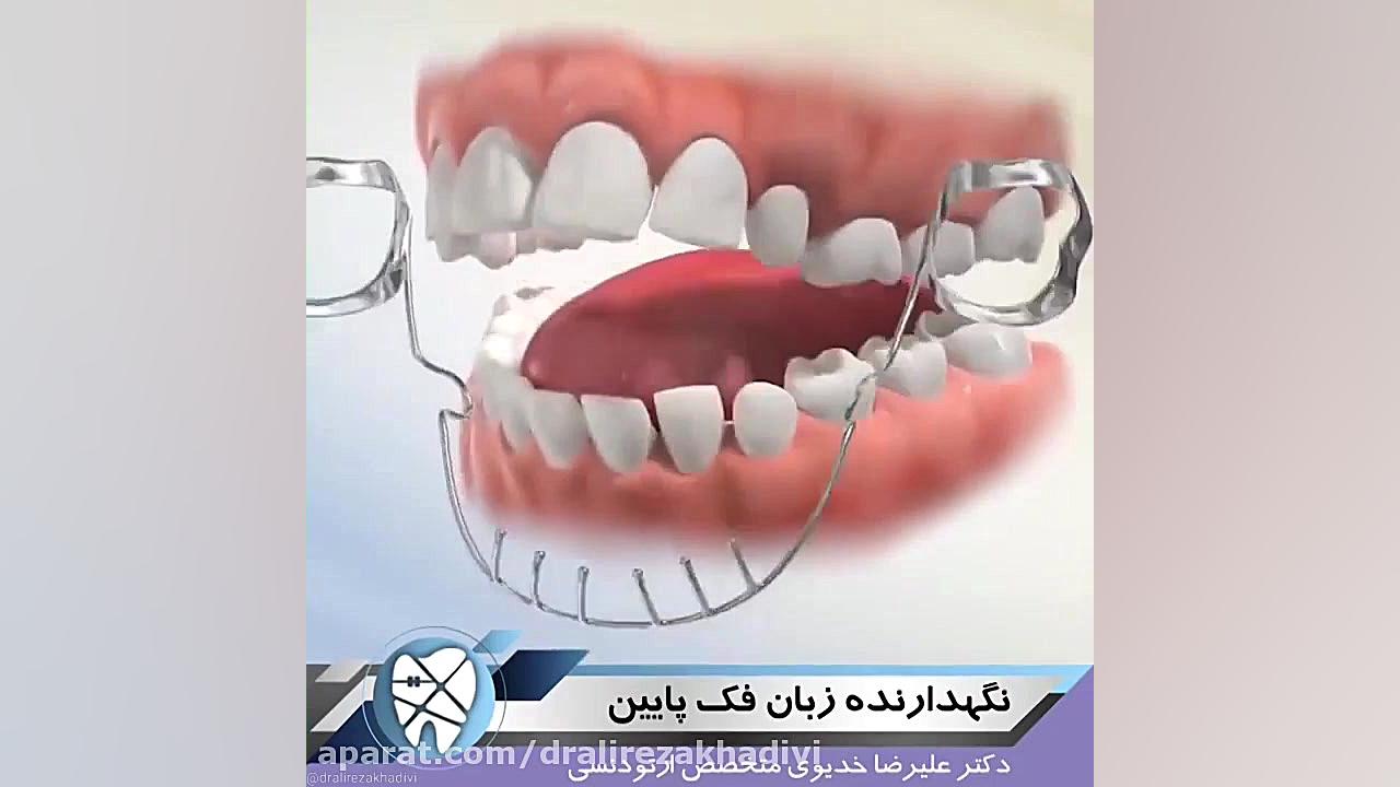 نگهدارنده زبان فک پایین.متخصص ارتودنسی دکترعلیرضاخدیوی دکتر علیرضا خدیوی