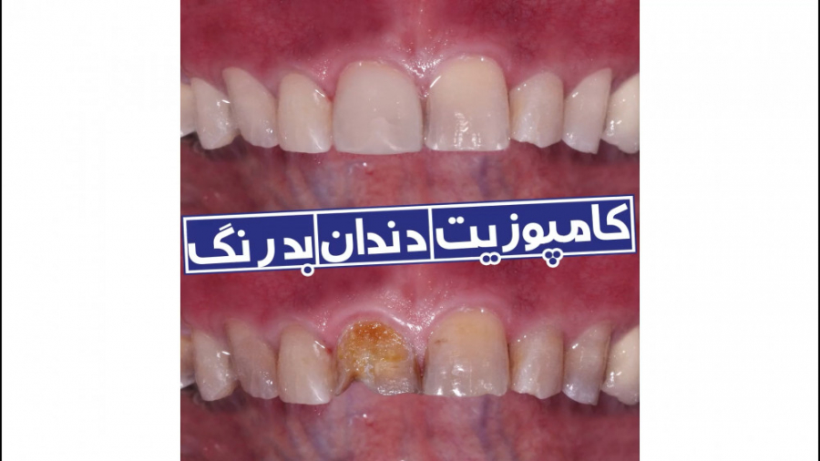 کامپوزیت بهترین گزینه برای اصلاح بدرنگی دندان‌ها | سیمادنت بیماری سندرم فریمن شلدون