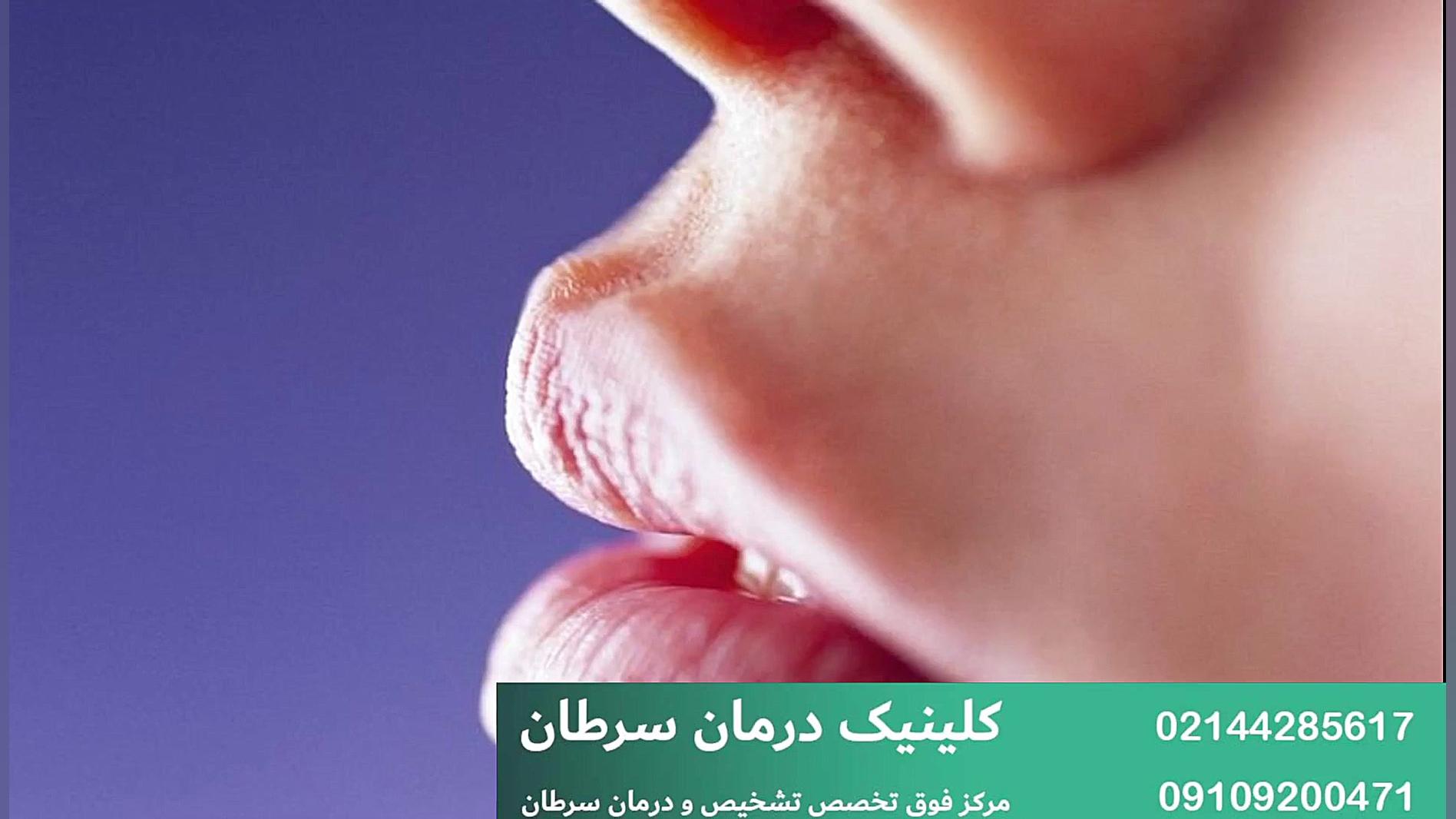 سرطان لب مرغ طوفان