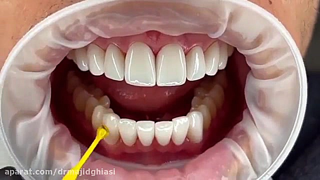 لمینت سرامیکی دکترمجیدقیاسی