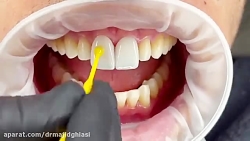 لمینت سرامیکی