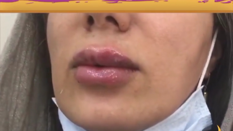 تزریق 1.5 سی سی ژل لب دکتر حمیده آقایی