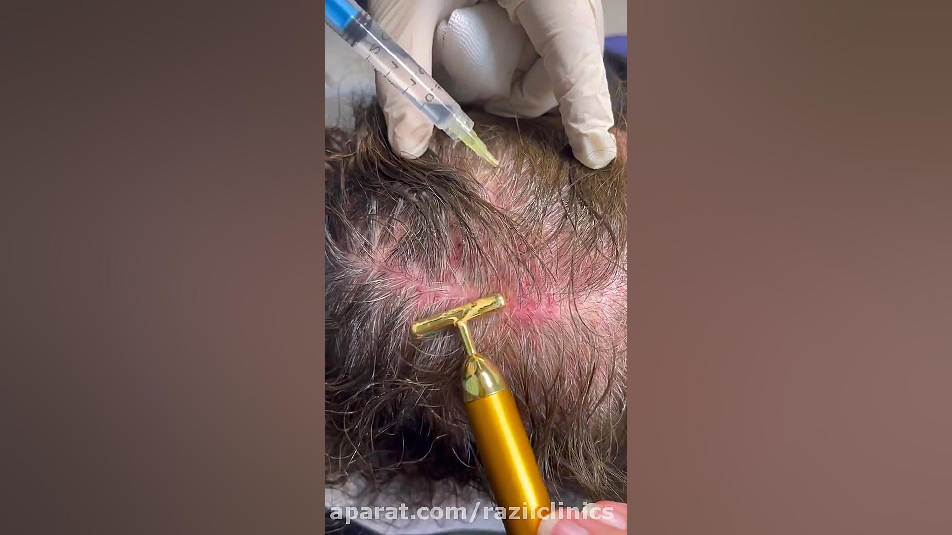 تزريق مزوتراپي بیماری بهجت