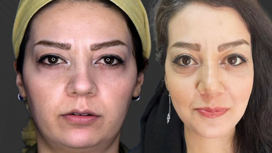 اصلاح فرم فک و چانه - جراحی تخصصی فک و صورت آکنه