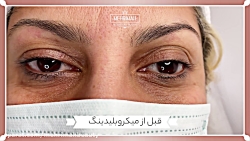 فیبروز ابرو کلینیک مهریماه سعا...